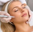 Microneedling
